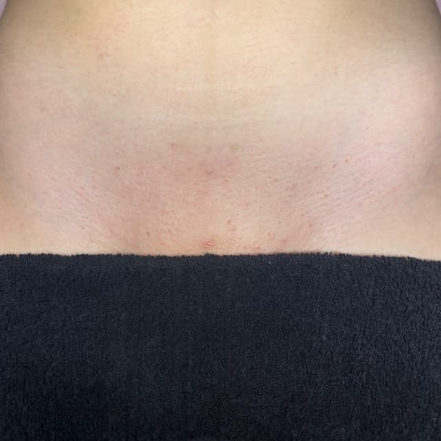 6 Months of Brazilians at Her Beauty in San Jose, CA